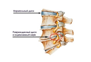 Simptomele osteocondrozei cervicale