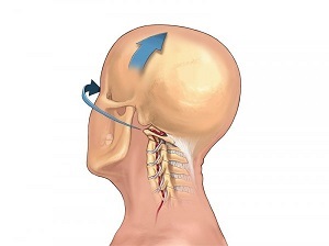 modul în care se manifestă osteocondroza coloanei cervicale