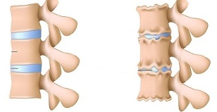 cum să recunoaștem prezența osteocondrozei coloanei lombare