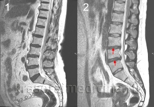 osteochondrosis a coloanei vertebrale