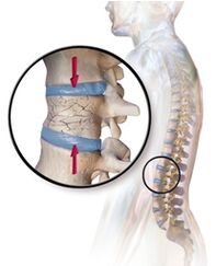 Osteoporoza provoacă dureri de spate în regiunea lombară